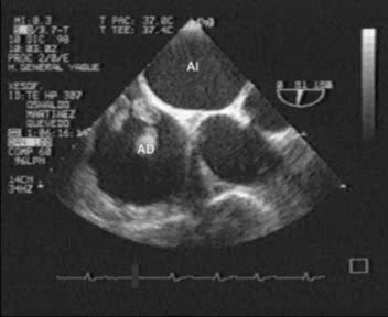  Figura 6.- Trombo en aurí­cula derecha en plano de ecocardiografia transesofagica (ETE).