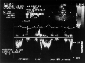 Figura 9.- Tiempo de aceleración de la arteria pulmonar o TSVD. Patrón tipo III.