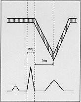 Figura 8.- Tiempo de aceleración de la arteria pulmonar o TSVD. Patrón tipo I.