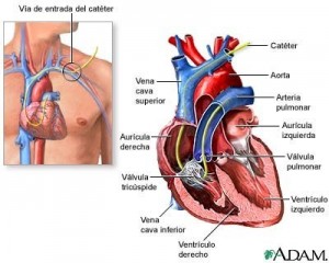 Catéter de arteria pulmonar