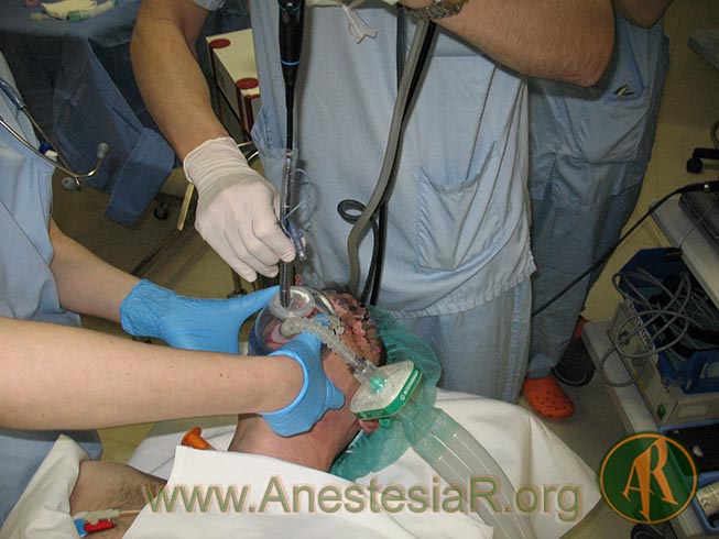 Efecto de la maniobra de tracción mandibular en el avance del tubo endotraqueal sobre el fibroscopio durante la intubación oral fibroscópica p