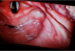 Glidescope identificando glotis y entrada esofágica.