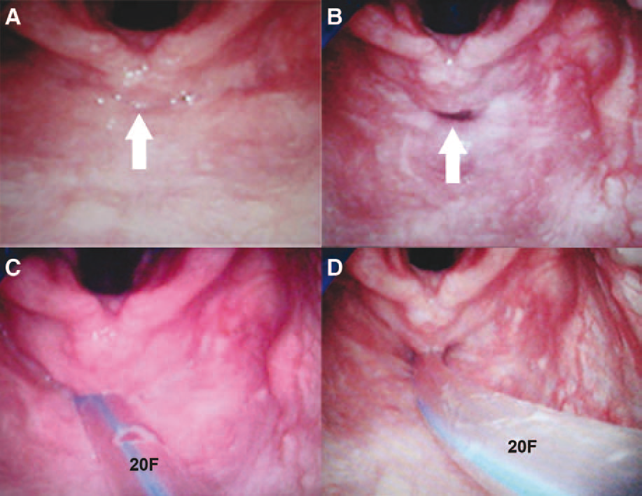 Zeidan, The effectiveness of cricoid pressure for occluding the esophageal entrance in anesthetized and paralyzed patients, an experimental and observational glidescope study
