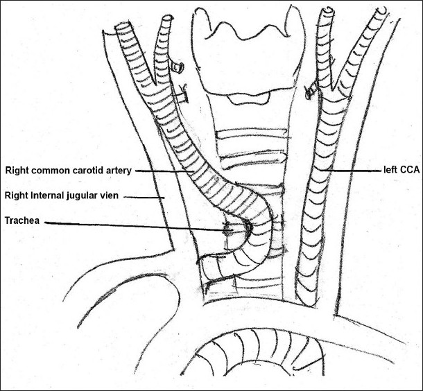 Common carotid artery surprise during percutaneous dilatational tracheostomy