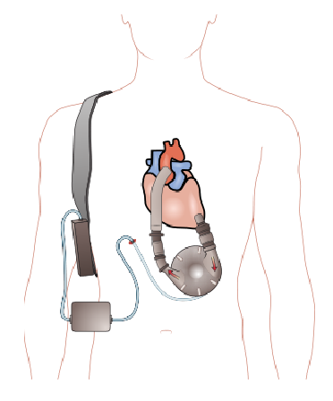 PCR en pacientes con dispositivos de asistencia ventricular (DAV) ERC -2015