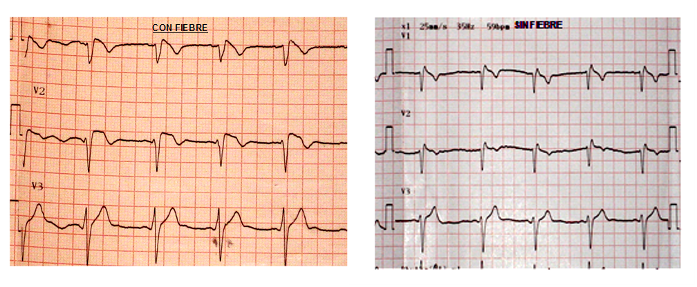 Figura 3: a la izquierda, ECG del paciente en el momento de ser admitido en quirófano, con registro febril de 38,8ºc, donde se observa un patrón de Brugada tipo I y a la izquierda, ECG del mismo paciente en el postoperatorio, en el que se evidencia un patrón de Brugada tipo III.