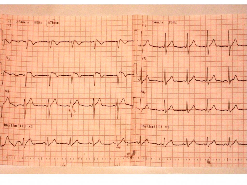 Figura 1: Electrocardiograma tomado en el momento del ingreso a urgencias, paciente con cuadro de fosa ilí­aca derecha y registro térmico de 38,8 ºC.