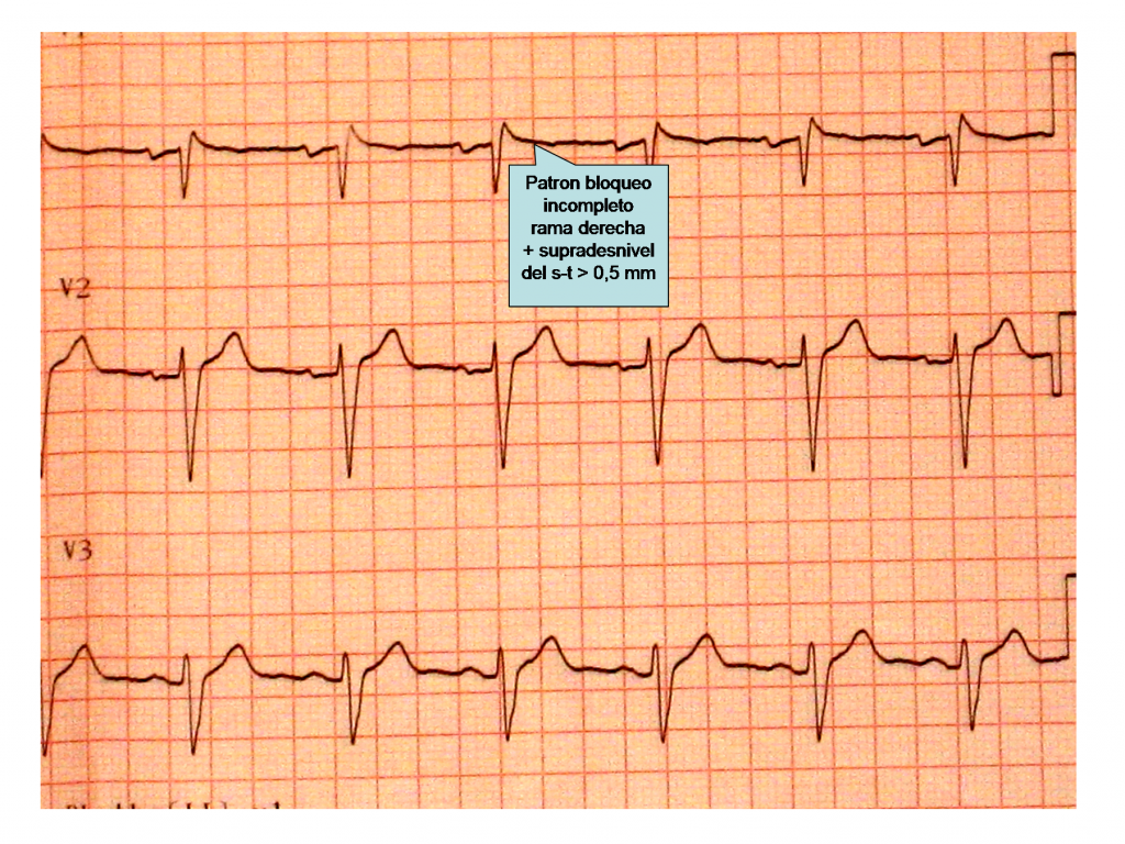 Figura 2: Electrocardiograma del padre del paciente en las derivaciones precordiales derechas de V1 a V3, en el cual se puede apreciar un patrón de bloqueo incompleto de rama derecha con elevación del punto“ j“ > 0,5 mm.