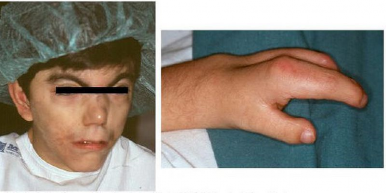 Resultado de imagen para cornelia de lange cirugia