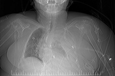 Hemotórax: Placa de tórax portátil tras colocación de DET. Hemotórax izquierdo masivo.
