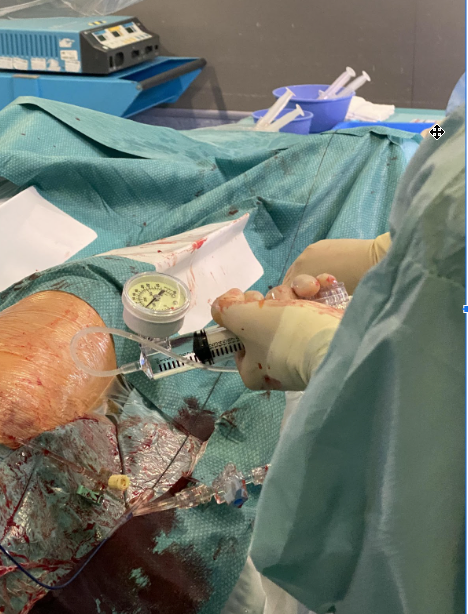 Dilatación de balón endovascular en cirugía de revascularización de miembros inferiores