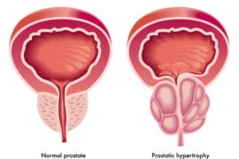 Hiperplasia benigna de próstata