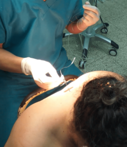 Colocación de epidural cervical en hemitiroidectomía