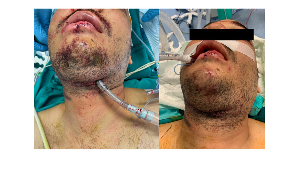 Figura 2. (Izquierda) Intubación submentoniana mediante incisión de 2 cm de tamaño en localización paramediana izquierda. (Derecha). Reconversión de intubación submentoniana a orotraqueal y sutura quirúrgica tras finalizar la cirugía.