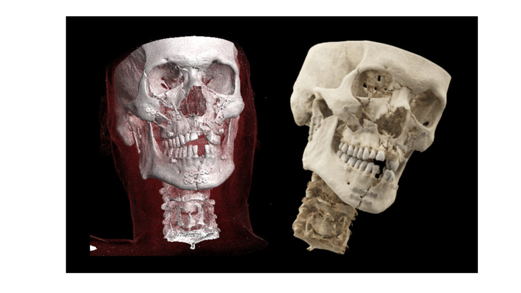 Figura 3. Reconstrucciones volumétricas 3D a partir de imágenes de tomografía computarizada (TC) postquirúrgicas. Osteosíntesis múltiples mediante placas y tornillos de las fracturas descritas anteriormente.
