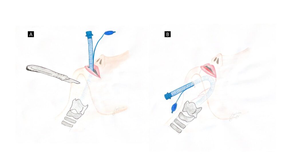 Figura 4. Presentación gráfica de la intubación submentoniana. (A) Localización de la incisión. (B) Reposicionamiento del tubo endotraqueal.