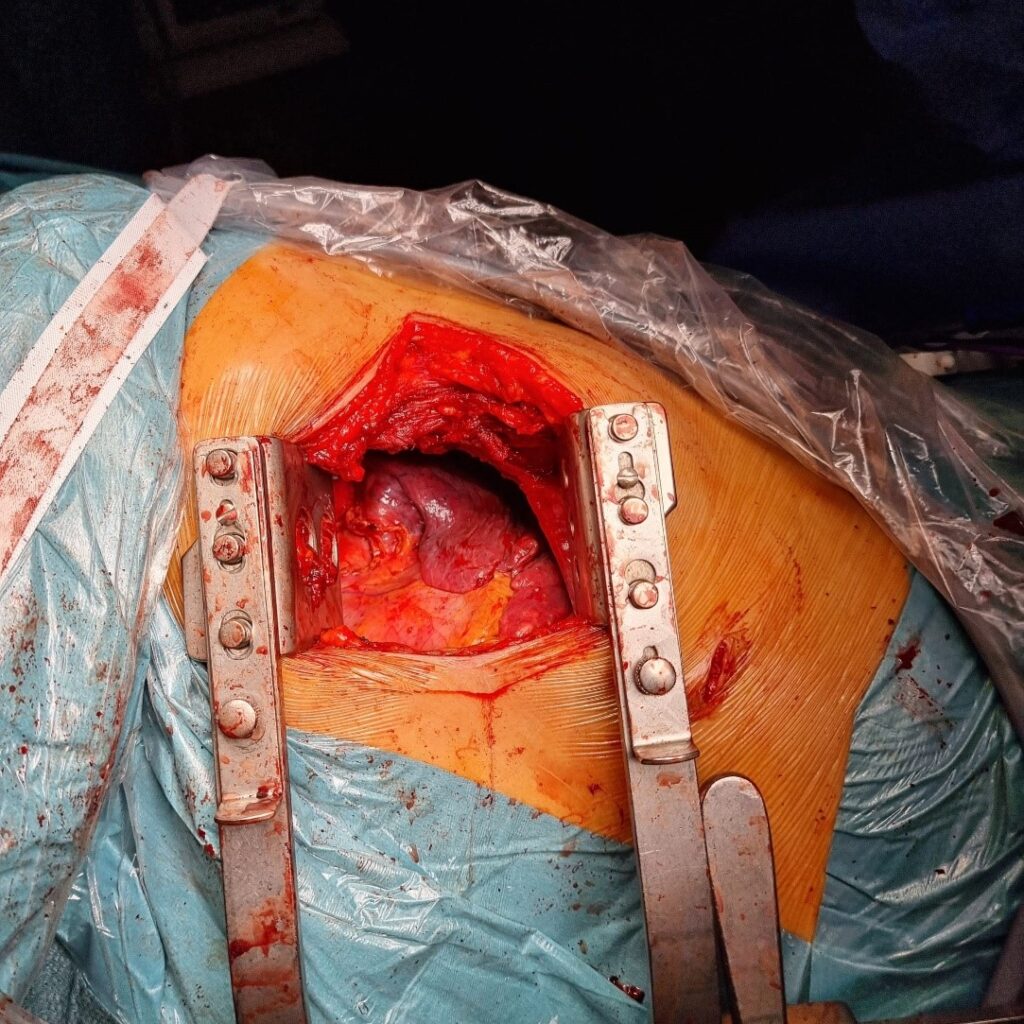 Toracotomía posterolateral.