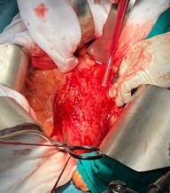 Figura 2a. Apertura de aneurisma de aorta abdominal.