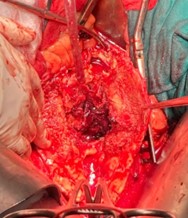 Figura 2b. Apertura de aneurisma de aorta abdominal.