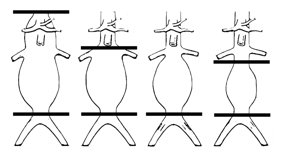 Figura 1. Niveles de clampaje aórtico según la localización del aneurisma.
De izquierda a derecha:
supraceliaco, suprarrenal, infrarrenal.